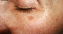 ¿MANCHAS EN LA PIEL? ESTO RECOMIENDA UNA ESPECIALISTA