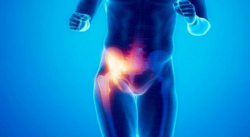 ¿SABES QUÉ ES LA PUBALGIA?